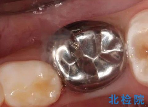 牙科預成根管樁測試